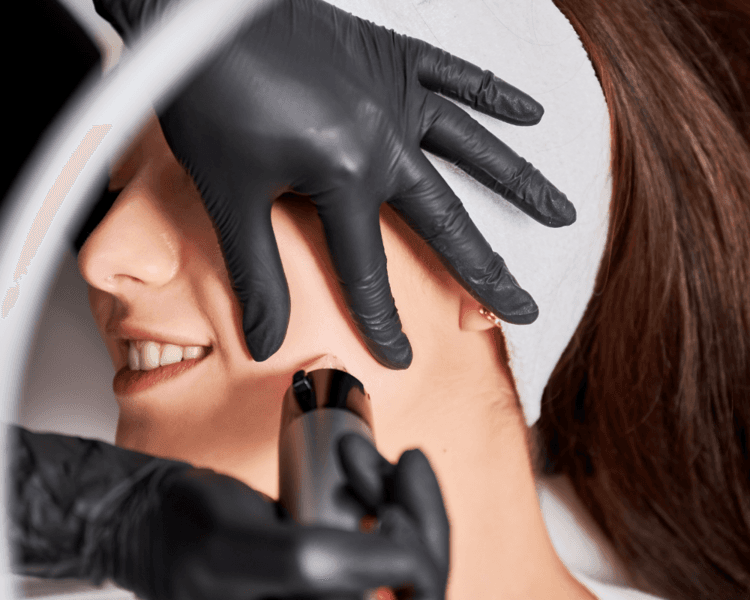 FACIAL ACNÉ | Extracciones y Control de Brotes