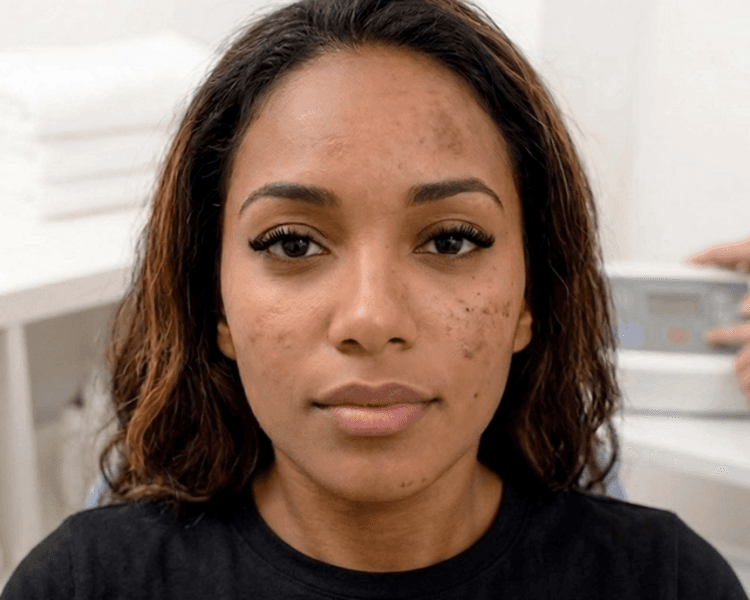 Higiene facial +ácidos