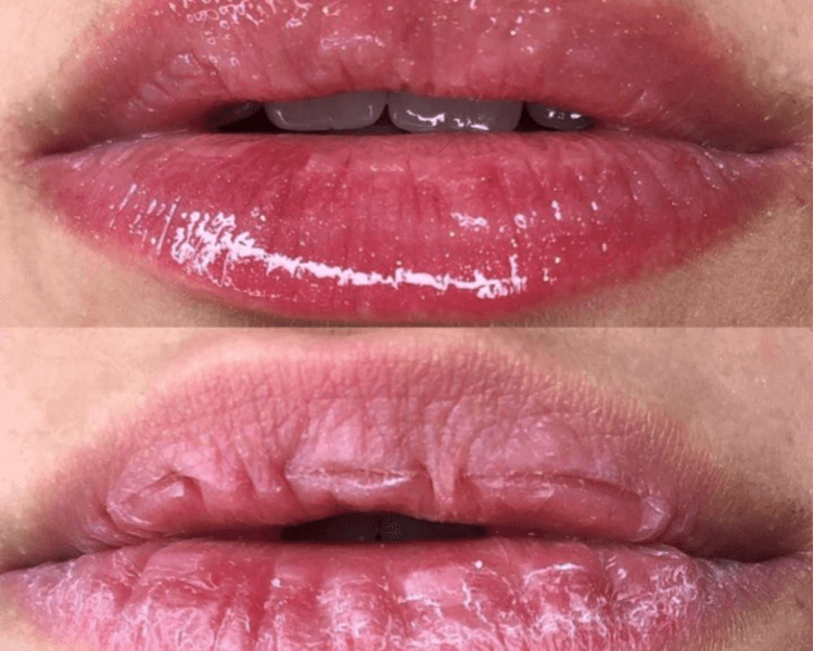 Hidralips con dermapen