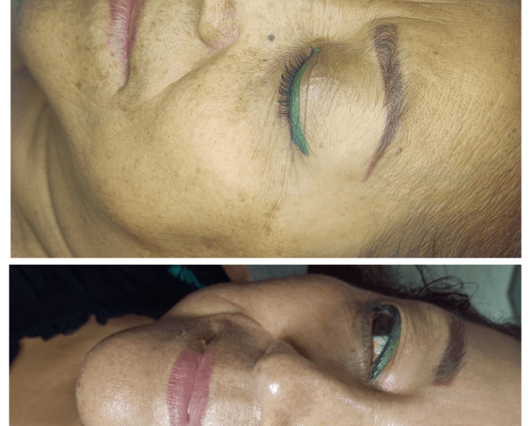 Limpieza facial profunda HIDRODERMOABRACION