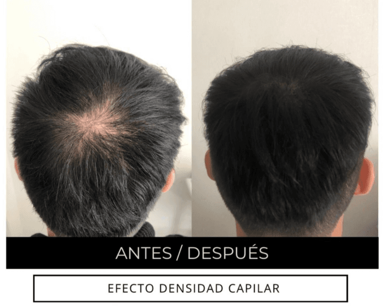 Micropigmentación Capilar – 1 zona