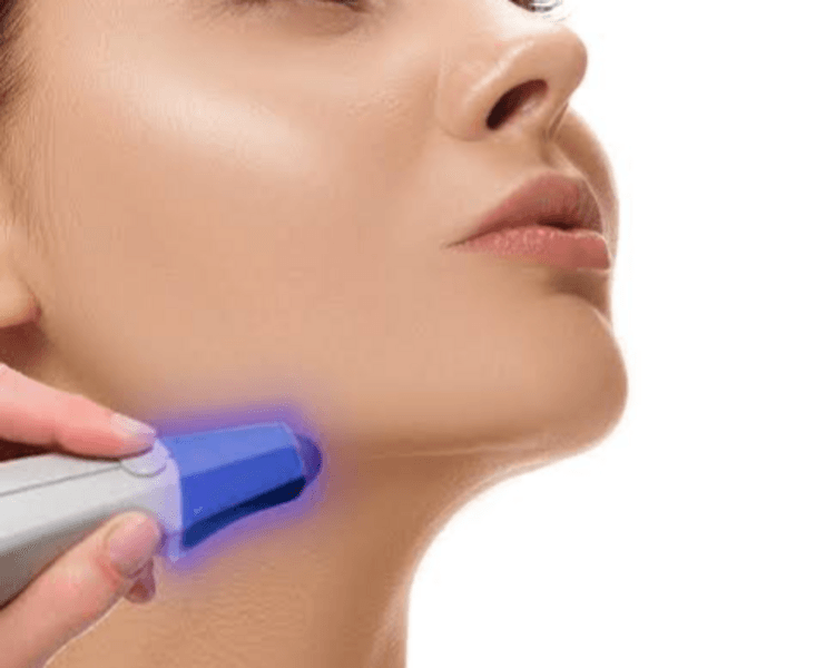 Papada+Cuello 6 sesiones
