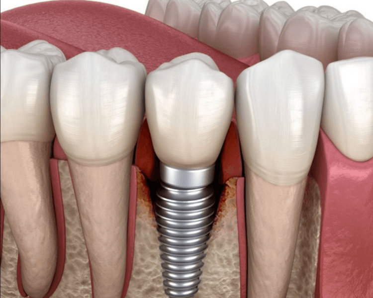 Consulta Implantes