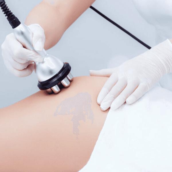 Radiofrecuencia o Diatermia + Presoterapia)ia