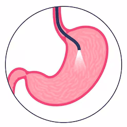 Foto de Endoscopía - Colonoscopía
