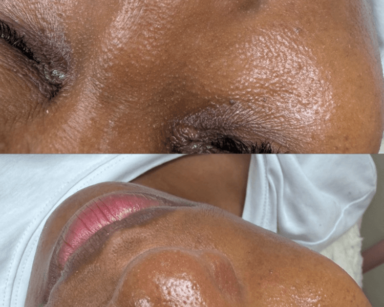 Limpieza facial profunda