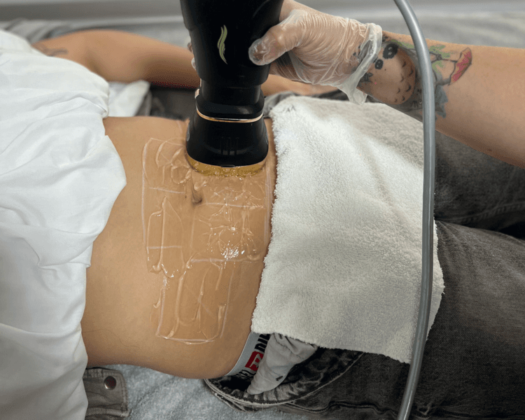 Liposonix + radiofrecuencia (1 zona)