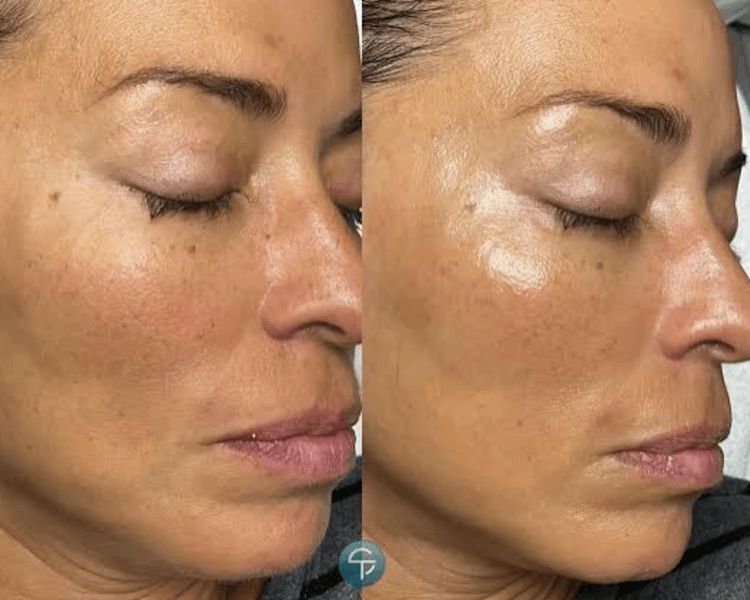 Dermaplaning