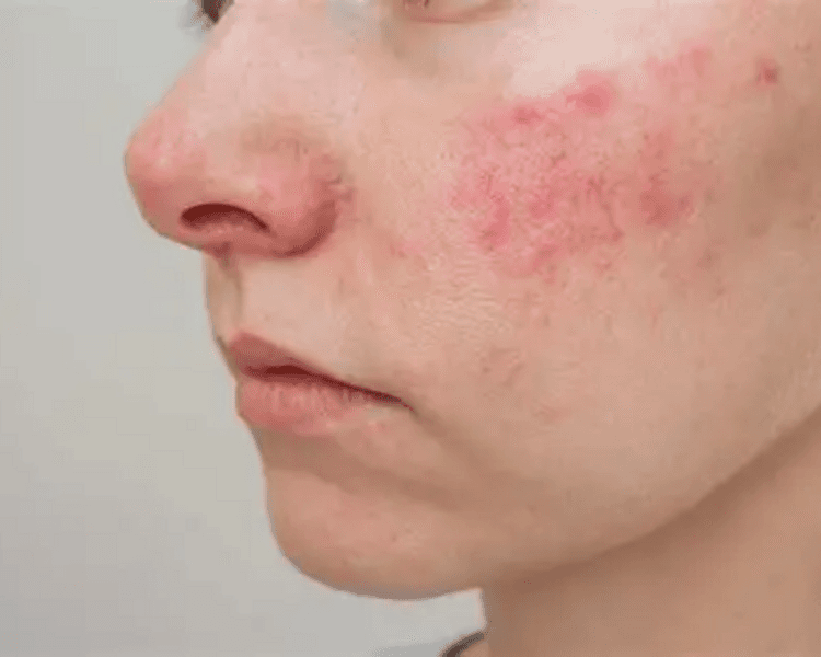 Peeling para acné, rosacea, piel grasa (Acido Azelaico)