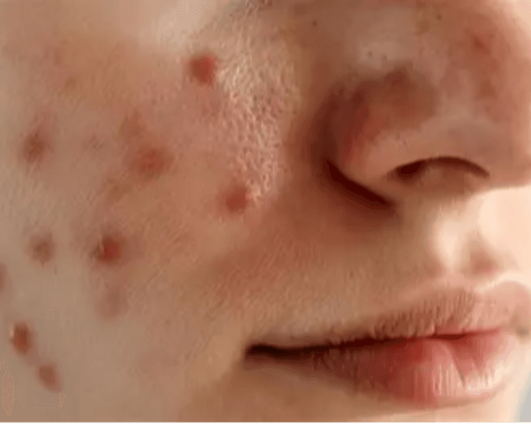Peeling despigmentante, manchas post acné, melasma