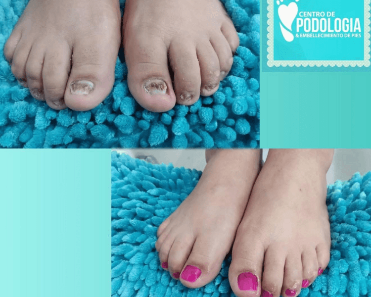 Servicio podologico con reconstrucción de uñas con Acrilico medicado