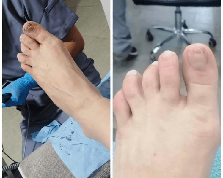 Tratamiento para uñas con onicomicosis avanzada