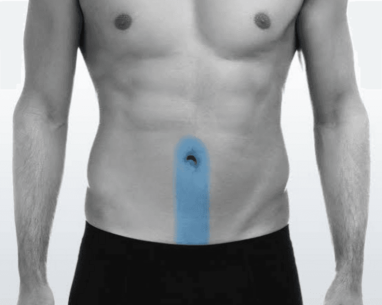 Depilación Láser Hombre: Abdomen - Línea Alba (6 sesiones)