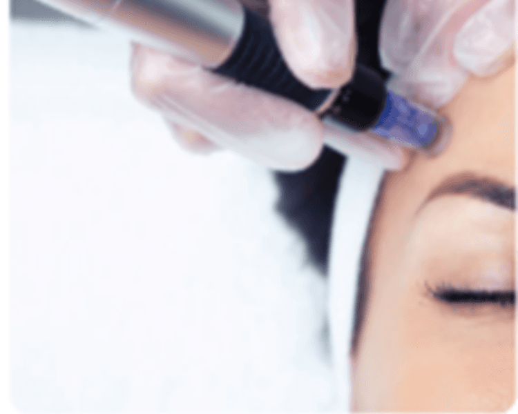VITAMINAS FACIALES CON DERMAPEN