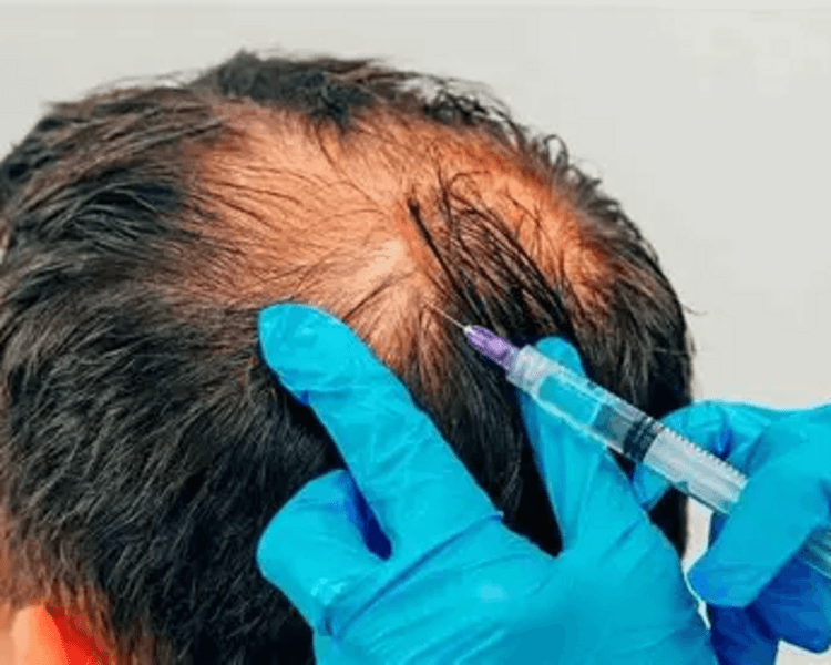 PLASMA RICO EN PLAQUETAS + EXOSOMAS BIOESTIMULACIÓN CAPILAR