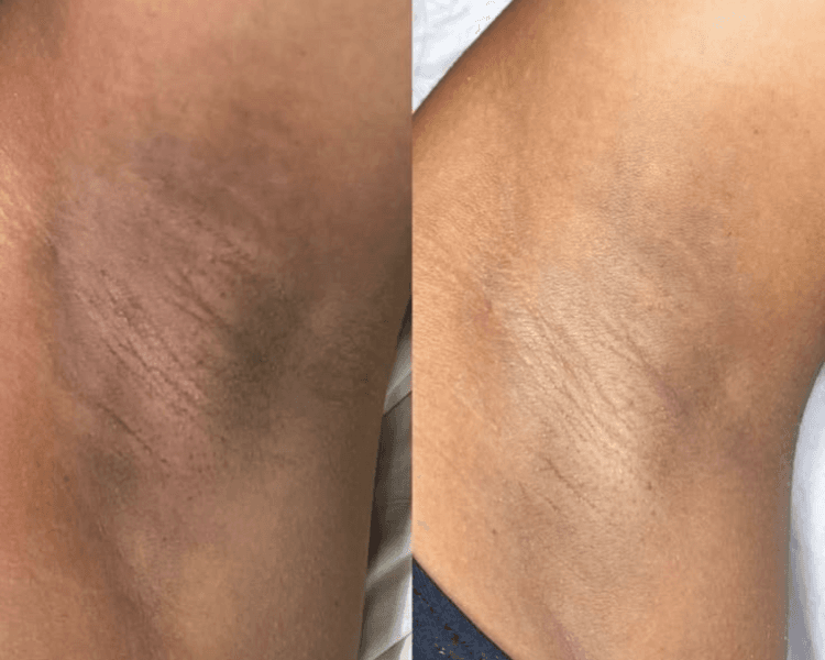 Peeling corporal