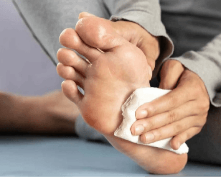 Tratamiento de hiperhidrosis con toxina botulínica