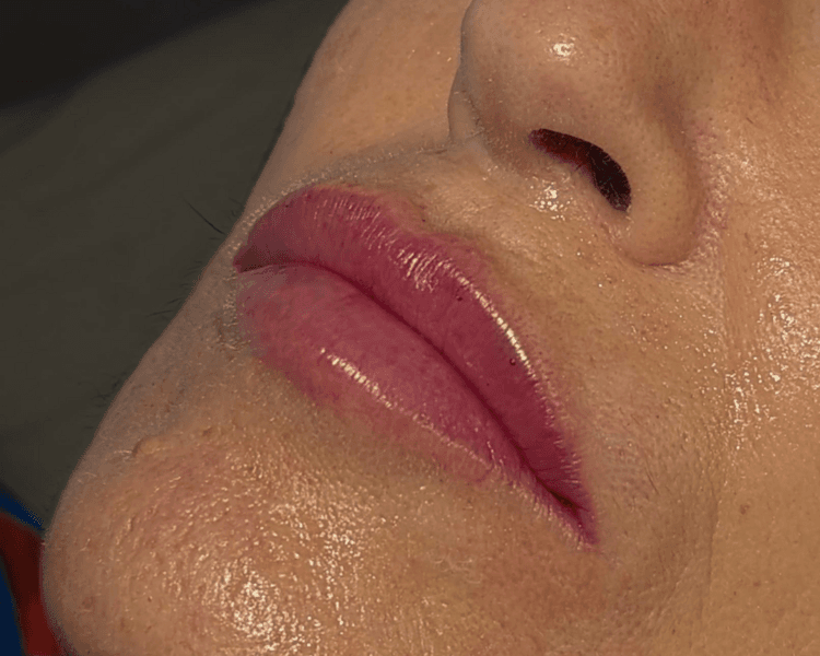 Armonización de labios con ácido hialurónico