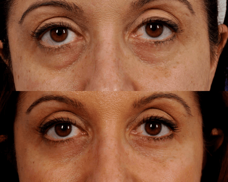 Tratamiento de ojeras con ácido hialurónico (desde)