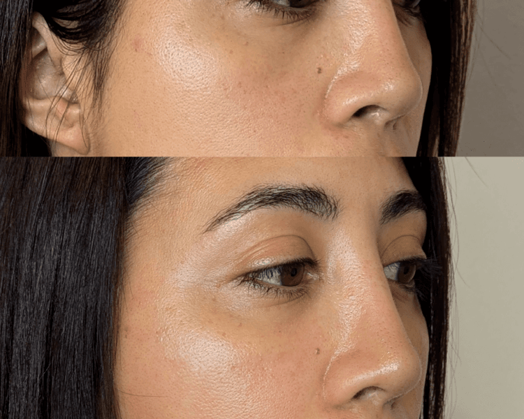 Armonización de tercio medio facial con ácido hialurónico (desde)
