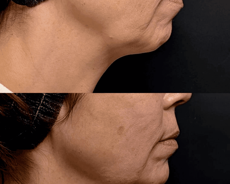 Definición del contorno mandibular con ácido hialurónico (desde)
