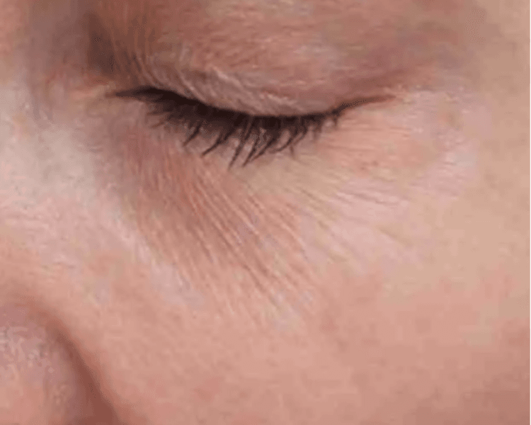Mesoterapia periocular con NCTF 135 HA (2 sesiones)