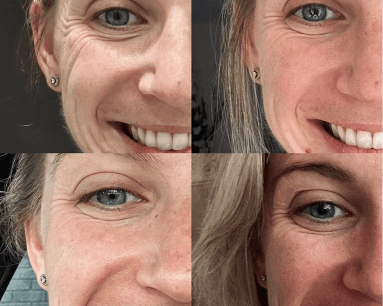 Skinbooster: hidratación profunda con ácido hialurónico (STYLAGE HIDROMAX)