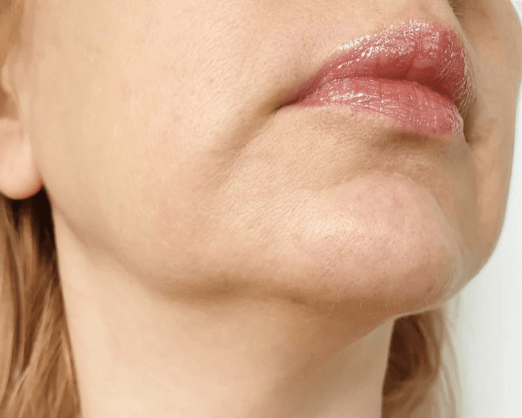 Tratamiento de adiposidad en rostro con CELLBOOSTER SHAPE (1 sesión)