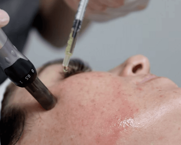 Plasma rico en plaquetas facial con dermapen (1 sesión)