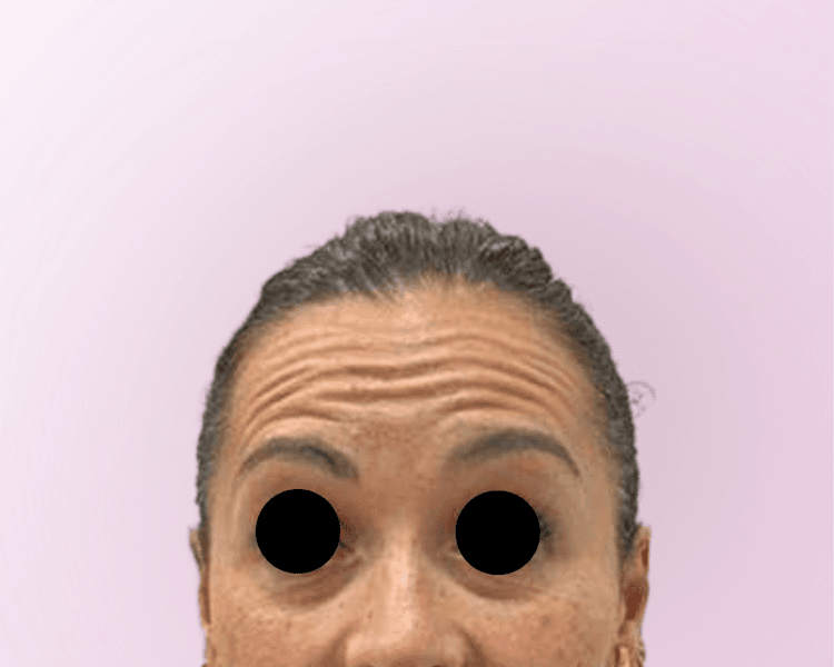 Toxina botulinica - BOTOX en Rostro