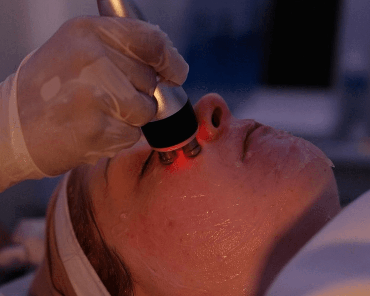 Sesión de Radiofrecuencia (Facial o Corporal)