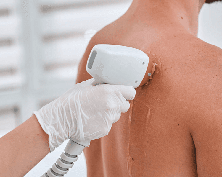 DEPILACION LASER 3 ZONAS (8 SESIONES) ANTES 287.500