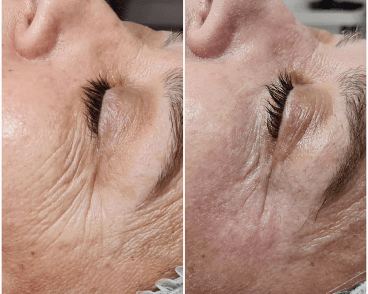 FIBROBLAST CUELLO (PLASMAPEN)
