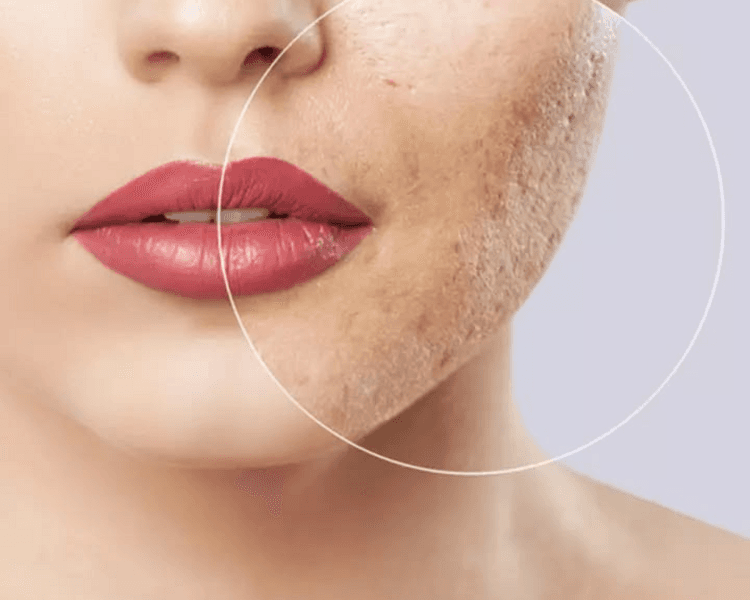 Acné Repair ✨