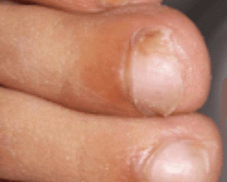ONICOMICOSIS (HONGOS EN LAS UÑAS)