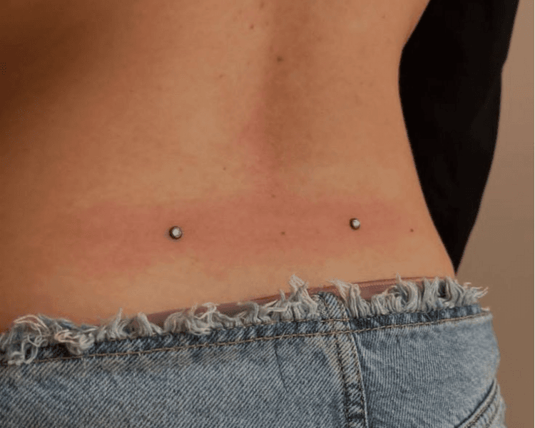 Microdermal