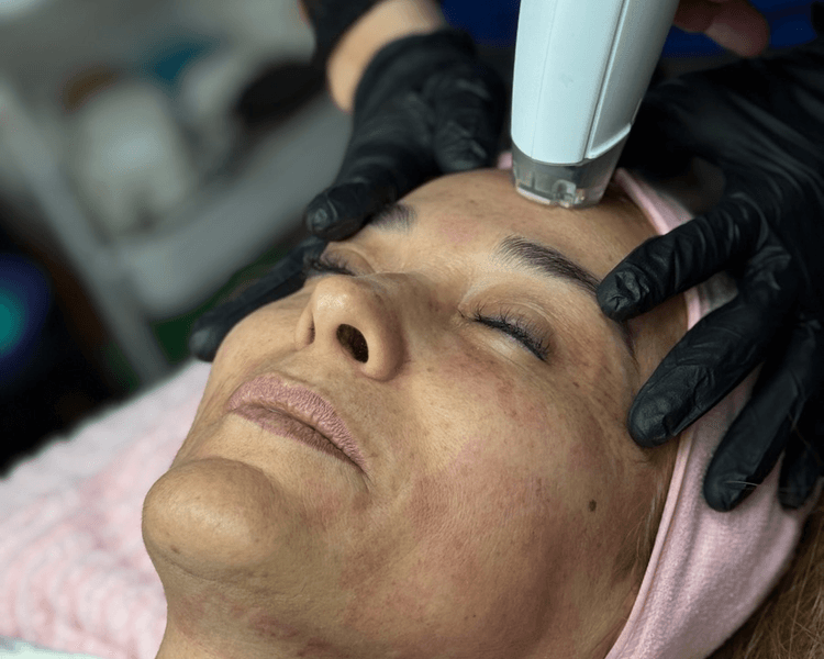 PACK 3 sesiones de Frax Face: Radiofrecuencia Fraccionada Facial