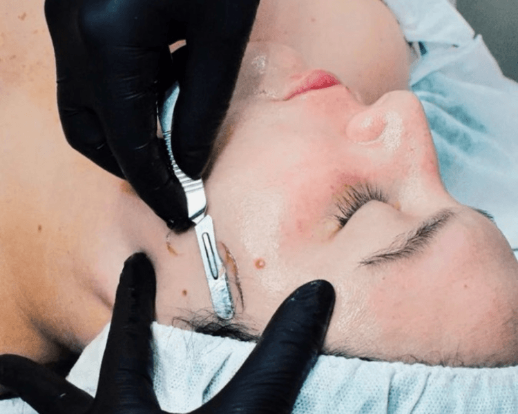 Dermaplaning Profesional