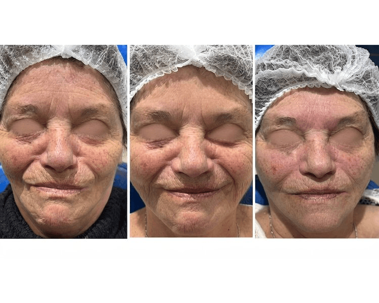 SKINBOOSTER
