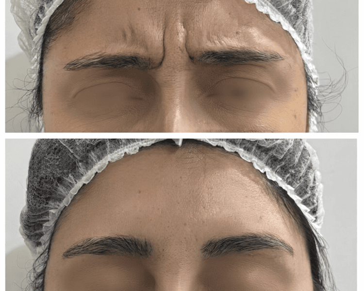 BOTOX FULL FACE