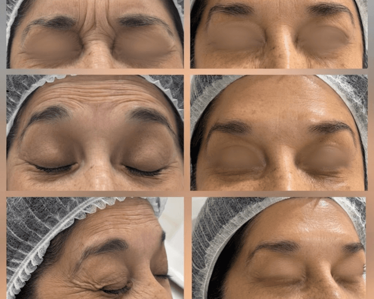 BOTOX TERCIO SUPERIOR