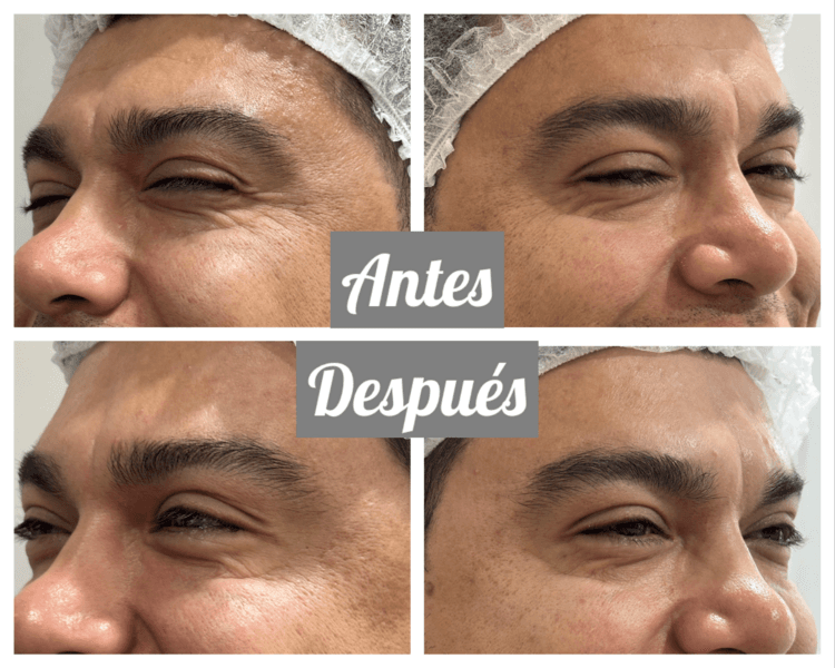 PACK FULL - DYSPORT + SKINBOOSTER