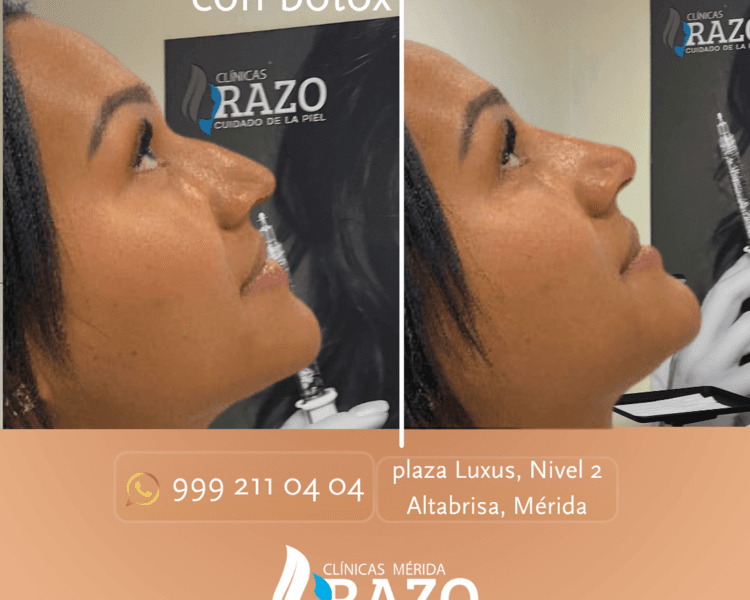 RINOMODELACIÓN CON BOTOX
