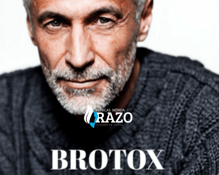 BOTOX FULL FACE - ALLERGAN