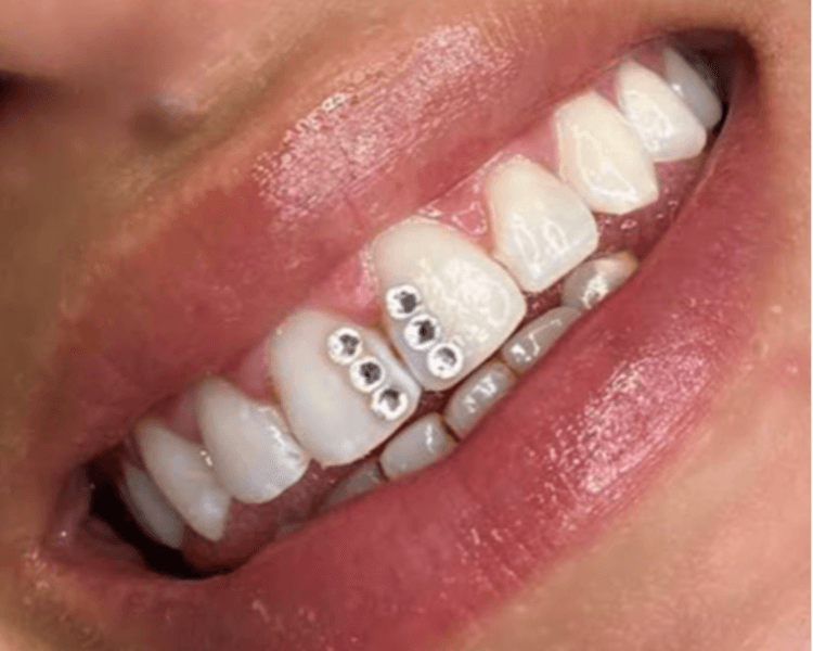 Joyería dental (3 cristales)