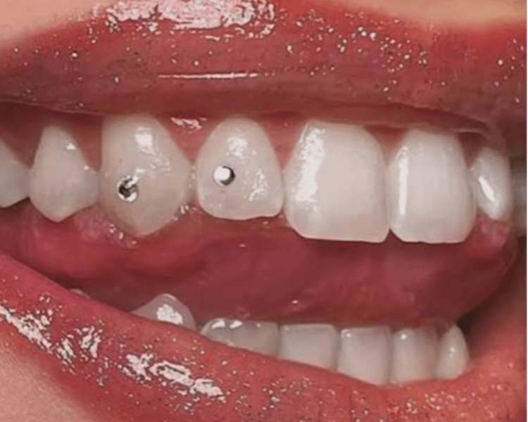 Joyería dental (2 cristales)