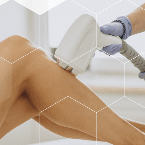 Depilación Definitiva Laser photo