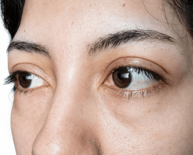 Blefaroedema_ Parpados, bolsas y ojeras