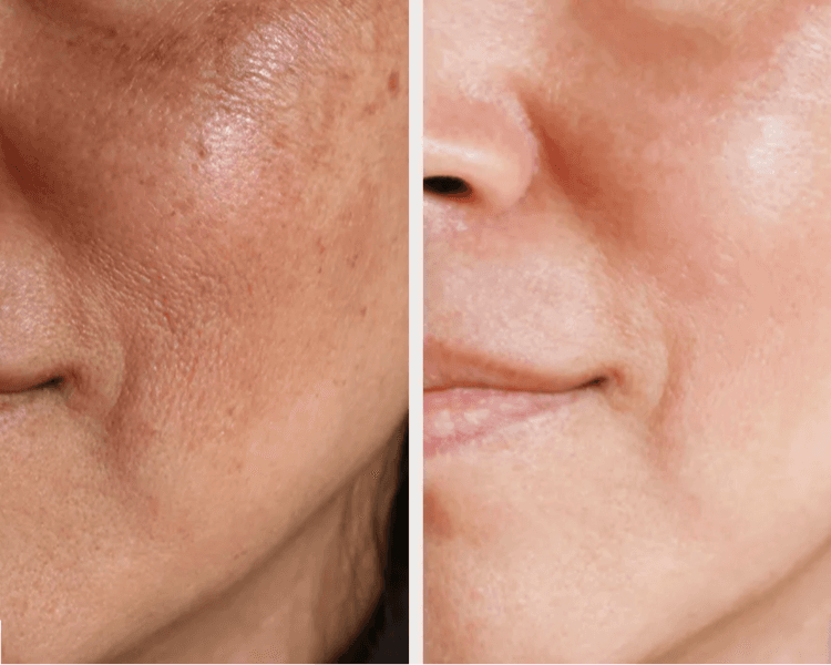 Toxina botulínica tercio superior + Meso Tox (con NCTF)