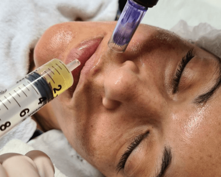 Limpieza + dermapen ( con hidralips)